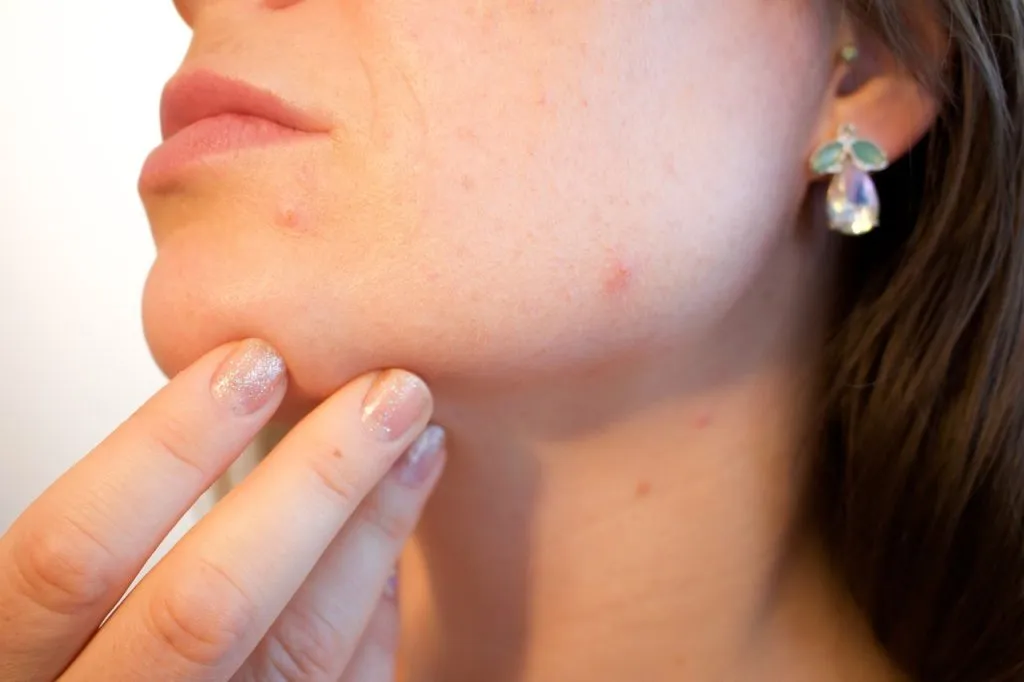 Faut_il_utiliser_du_maquillage_pour_cacher_son_acné_? Faut_il_utiliser_du_maquillage_pour_cacher_son_acné_?